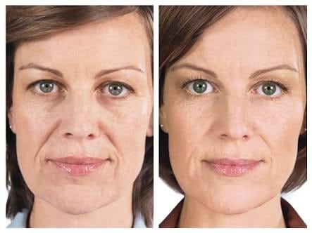 sculptra-conheca-o-metodo-para-renovacao-do-colageno-da-pele