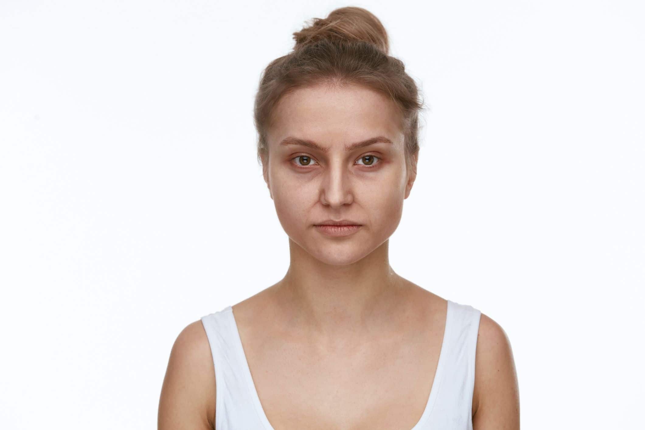 harmonização facial preenchimento com ácido hialuronico tratamento para olheiras preenchimento de olheiras